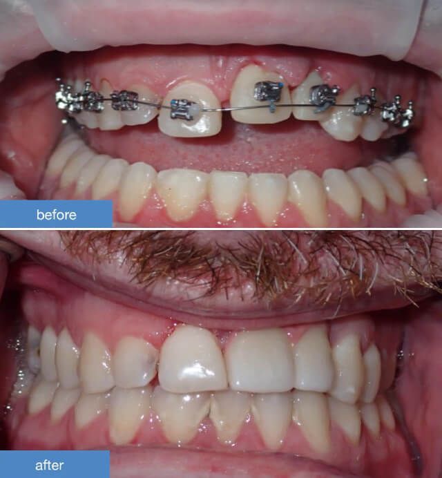 Orthodontics case 1