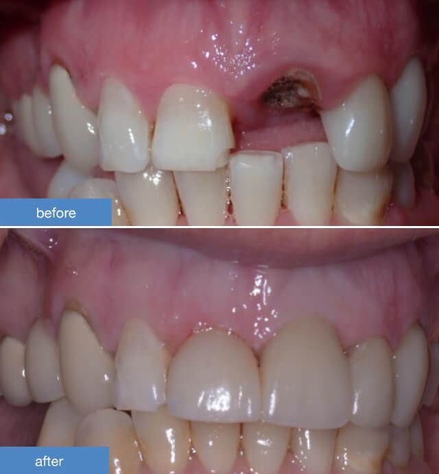 Dental Implants case 1