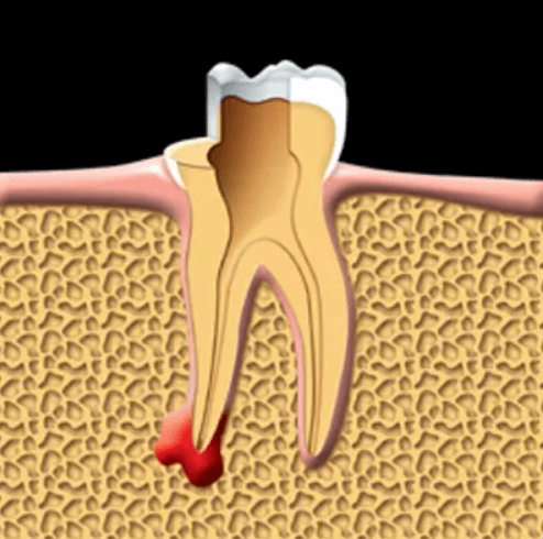 Root Canal Therapy – Maple Ridge Endodontics