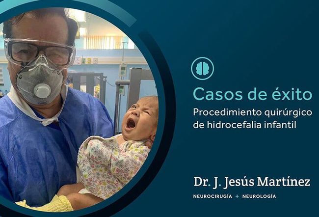 DR. J. JESÚS MARTÍNEZ  IBARRA- hidrocefalia infantil