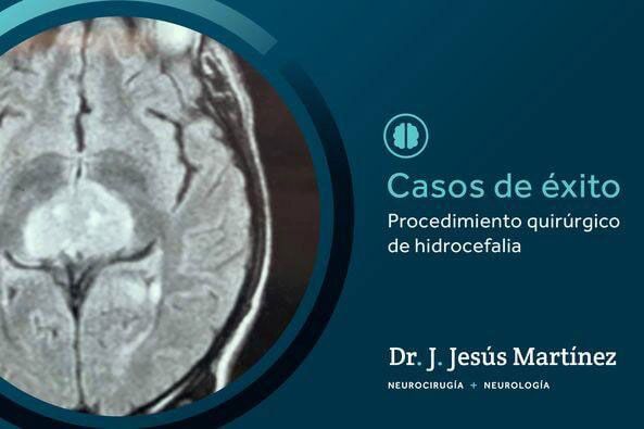 DR. J. JESÚS MARTÍNEZ  IBARRA- Síndrome de Parinaud
