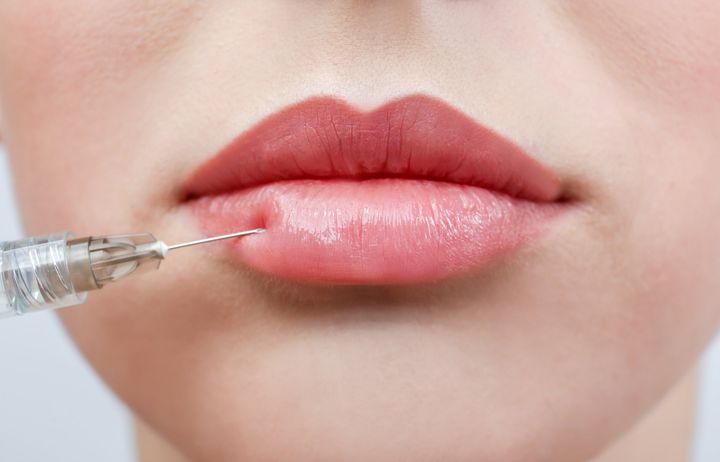 Image of dermal filler being injected into lips by dermatologist.