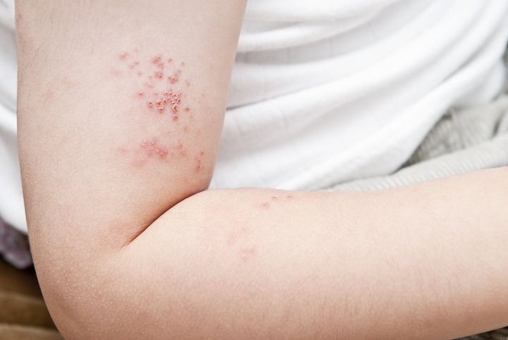 Image of skin infection on the arm that can be treated by a dermatologist.