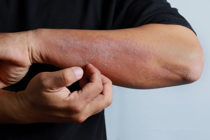 Image of dermatitis on forearm that can be treated by a dermatologist.