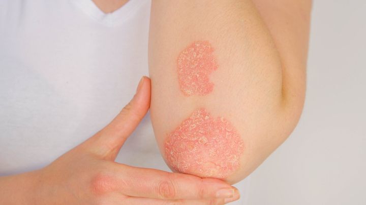 Image of psoriasis on elbow that can be treated by a dermatologist.