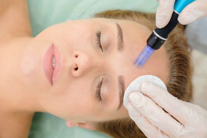 Image of a patient getting microneedling procedure from a dermatologist.