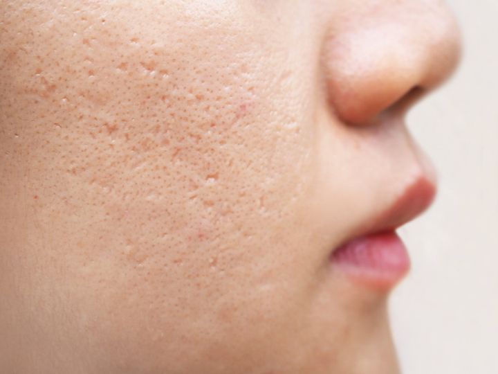 Image of acne scarring on face that can be treated by a dermatologist.