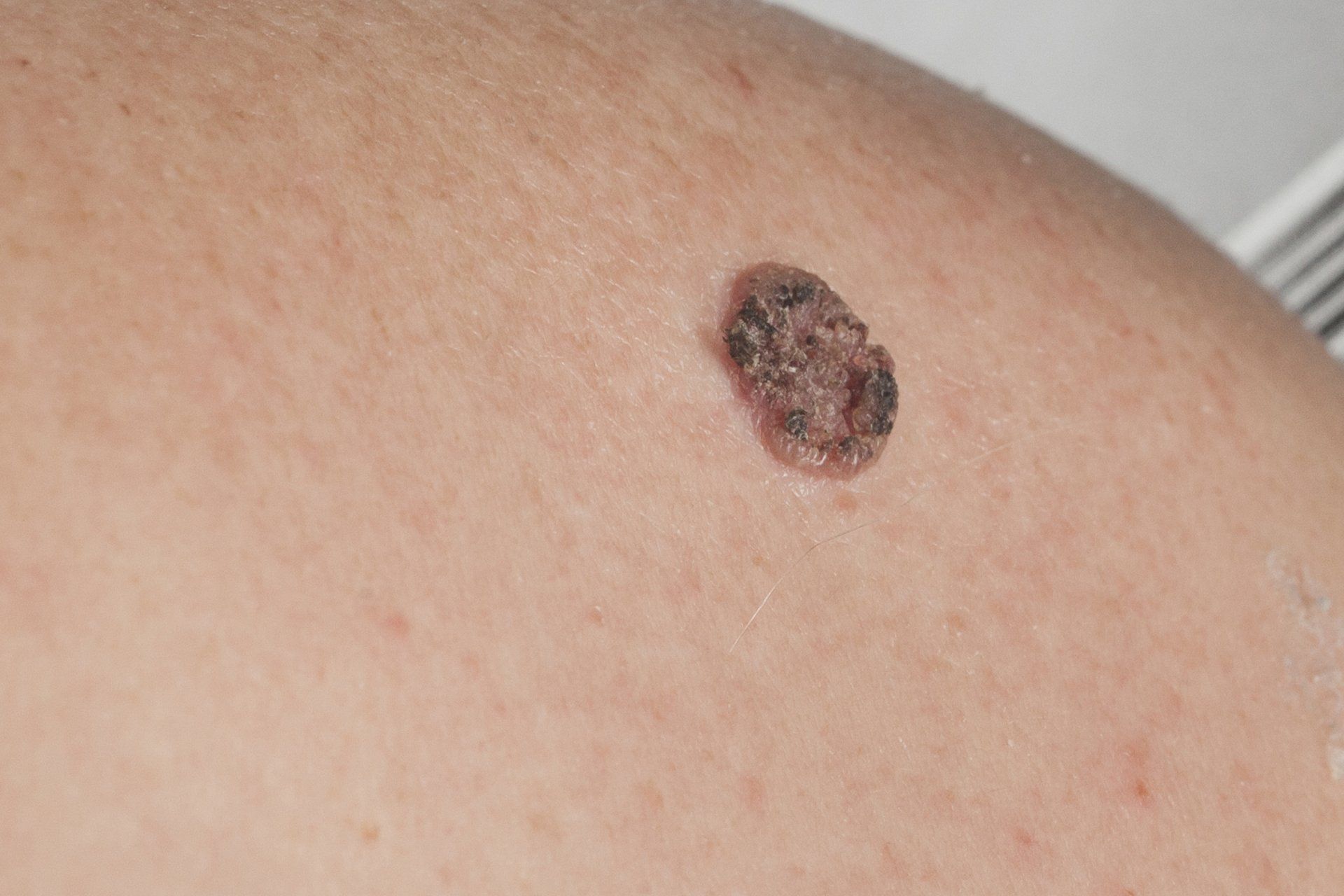 Image of  non-melanoma skin cancer treated by dermatologists.