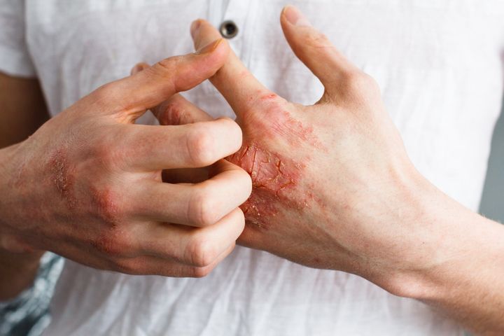 Image of eczema on hands that is treated by a dermatologist.
