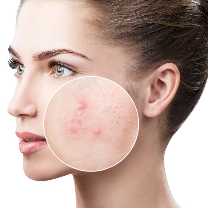 Image showing close up of acne that can be treated by a dermatologist.