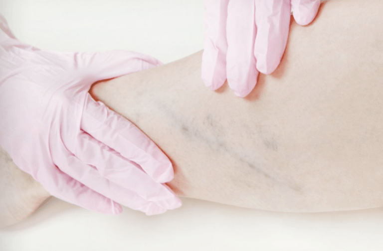 A person wearing pink gloves is examining a woman 's leg with varicose veins.