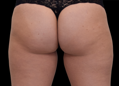 after emsculpt neo for buttocks