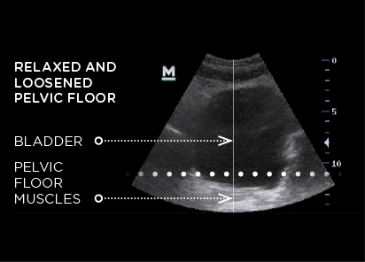 ultrasound of relaxed and loosened pelvic floor before emsella treatment
