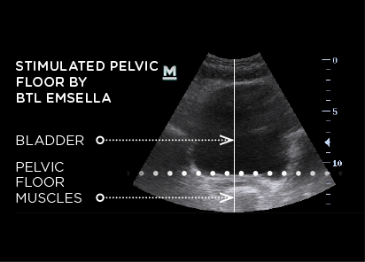 ultrasound of stimulated pelvic floor after emsella treatment