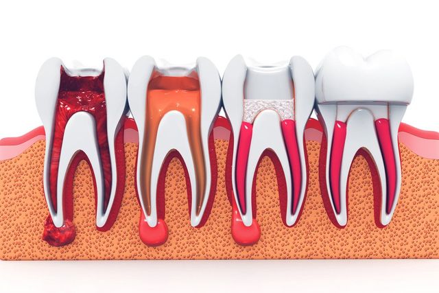 Tooth Saver: What's an Endodontist?