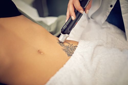 A Woman Is Getting A Tattoo Removed From Her Stomach - Latrobe, PA - Laser180