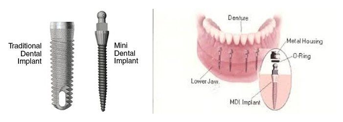 Mini Denture Impants Explaination