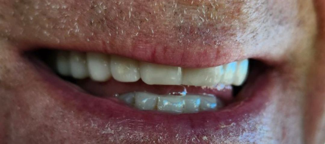 A close up of an elderly woman 's mouth and teeth