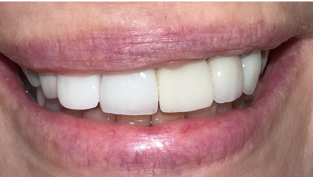 A close up of an elderly woman 's mouth and teeth