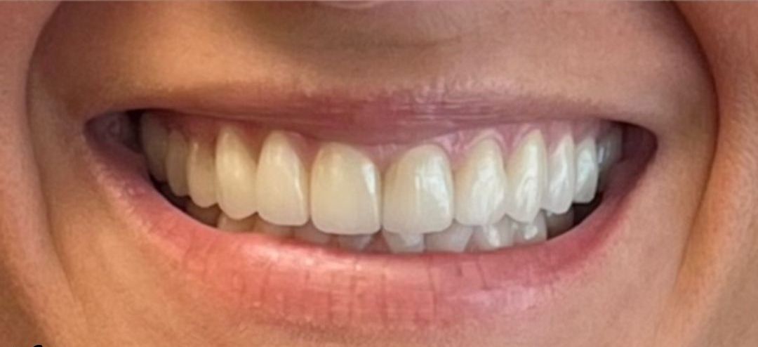 A close up of an elderly woman 's mouth and teeth