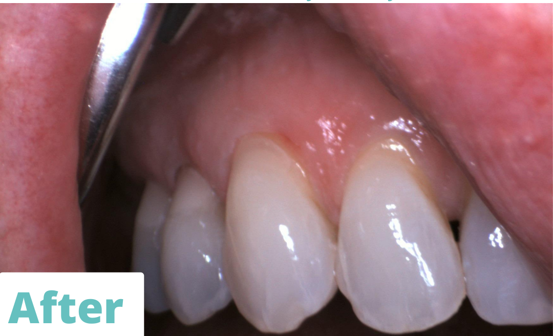 A close up of an elderly woman 's mouth and teeth