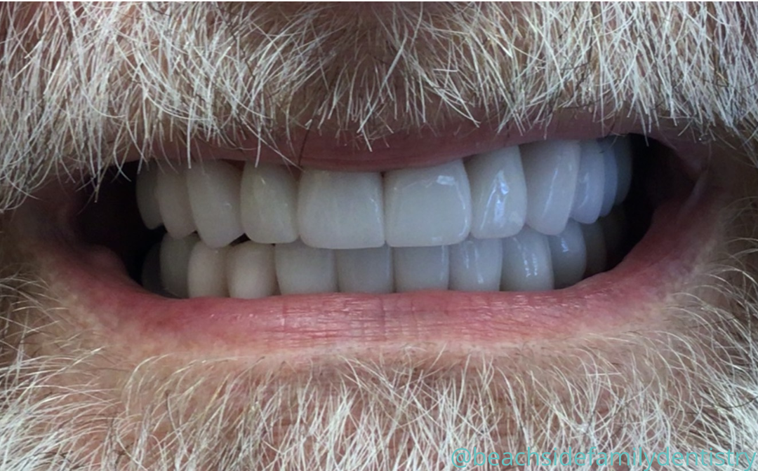 A close up of an elderly woman 's mouth and teeth