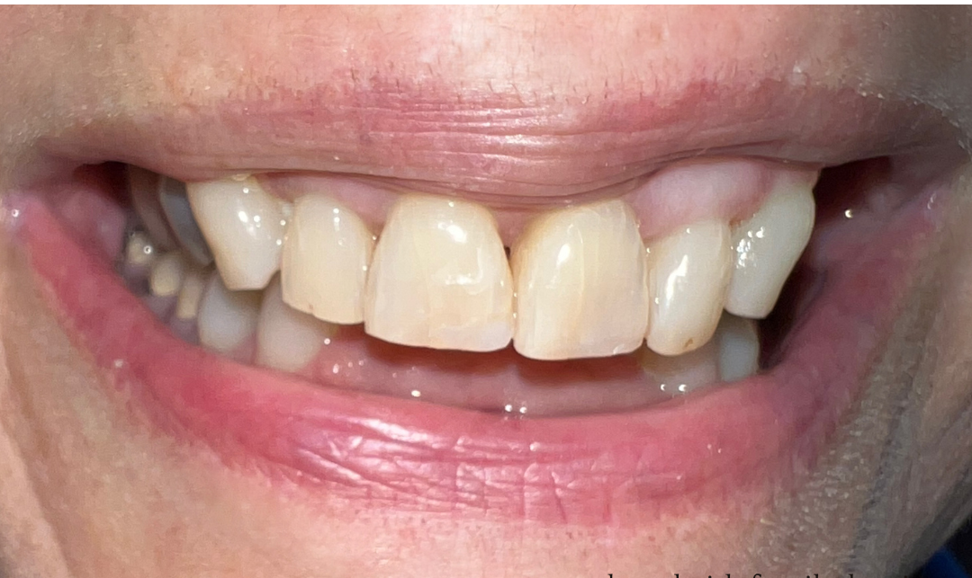 A close up of an elderly woman 's mouth and teeth