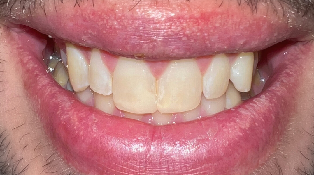 A close up of an elderly woman 's mouth and teeth