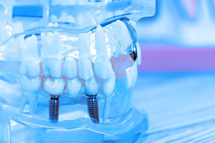 dental implants model up close