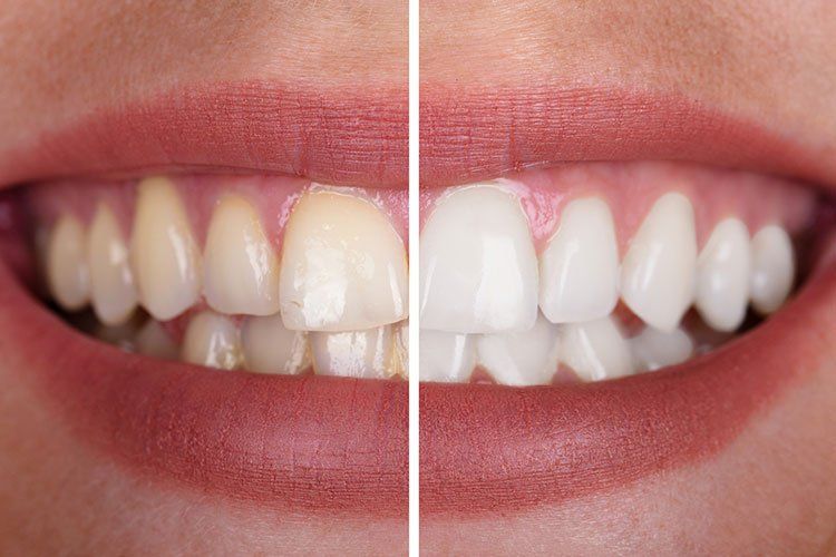 zoom whitening before and after