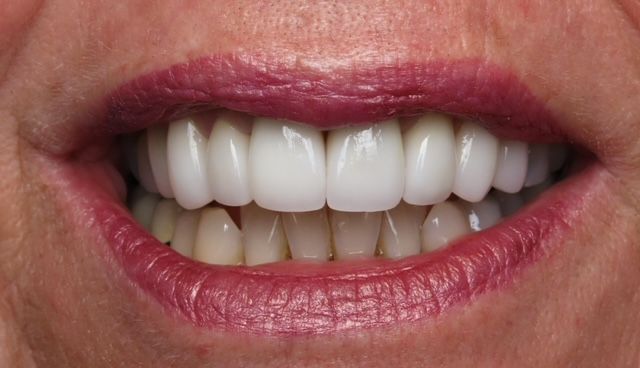 A close up of a woman 's mouth with white teeth and red lips.