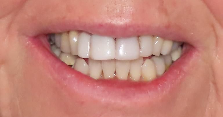 A close up of a person 's mouth with white teeth.