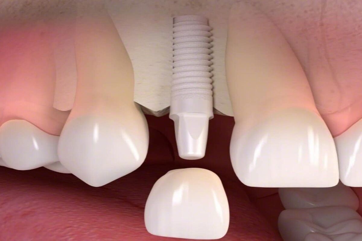 A computer generated image of a dental implant in a person 's mouth.