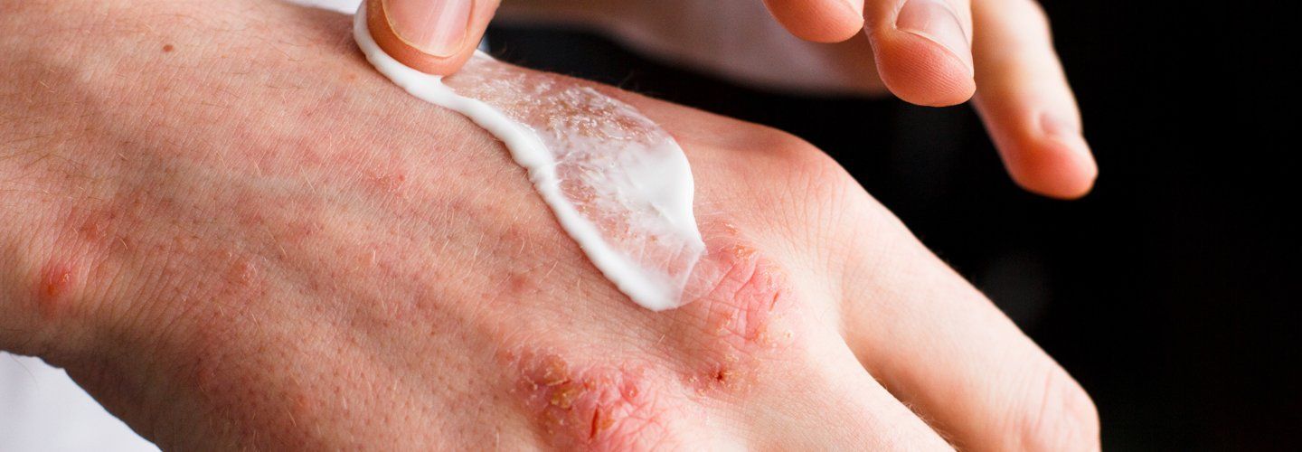 mettendo crema su eruzione cutanee in un mano