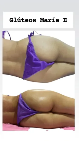 Comparación del antes y el después de un tratamiento de remodelación de glúteos, mostrando a una persona acostada de lado