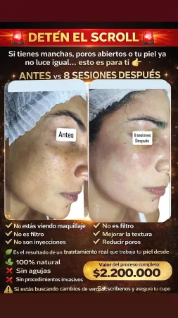 Comparación del antes y el después de la piel tras 8 sesiones de un tratamiento de belleza para reducir manchas y poros.