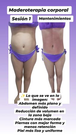 Comparación del antes y el después del tratamiento corporal de maderoterapia, que muestra un abdomen