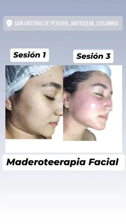 Comparación del antes y el después de un tratamiento facial para la piel, que muestra una reducción de la hiperpigmentación