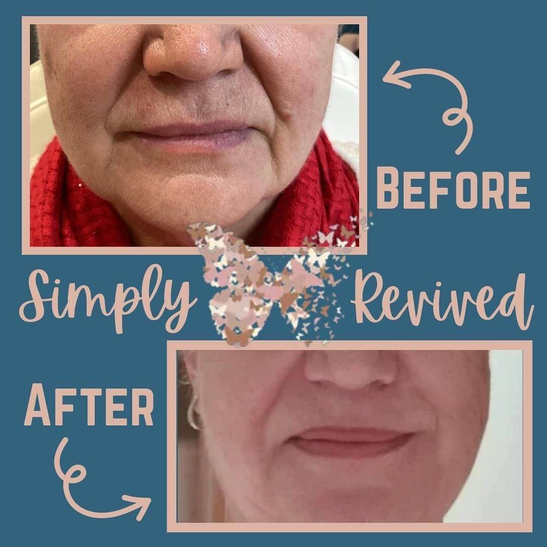 Before and after photos of lip enhancement; showing improved lip shape and reduced wrinkles.