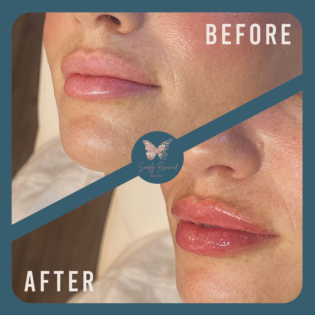 Comparison of lips before and after lip filler treatment, showing increased volume and redness.