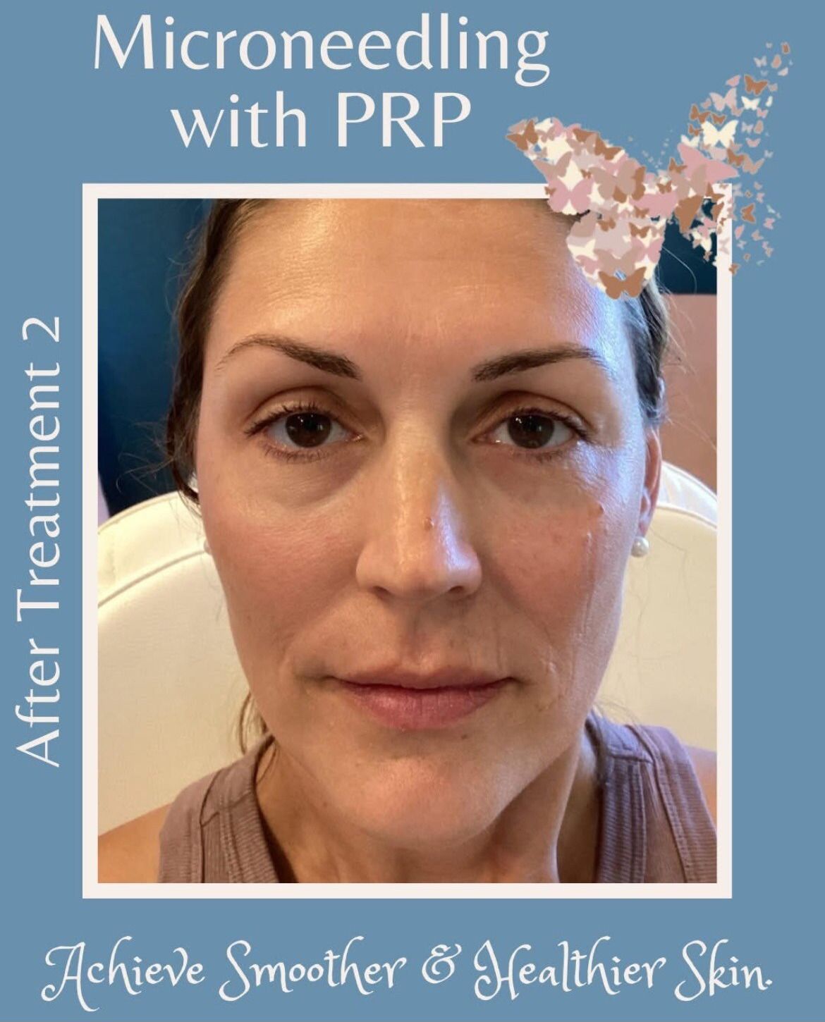 A woman's face after microneedling with PRP. Text reads 