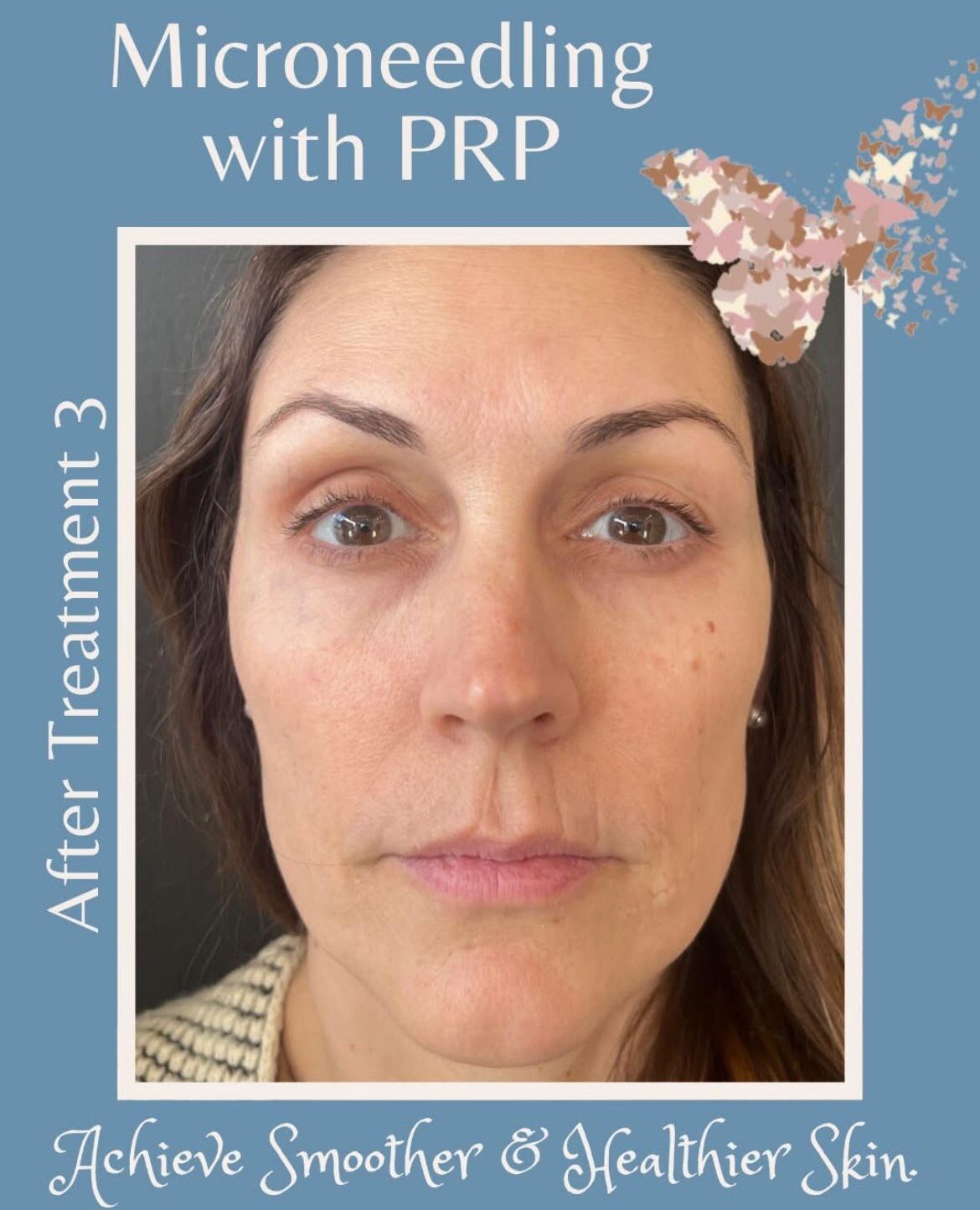 Woman's face after microneedling with PRP treatment. Blue background, butterfly graphic, text indicates smoother skin.
