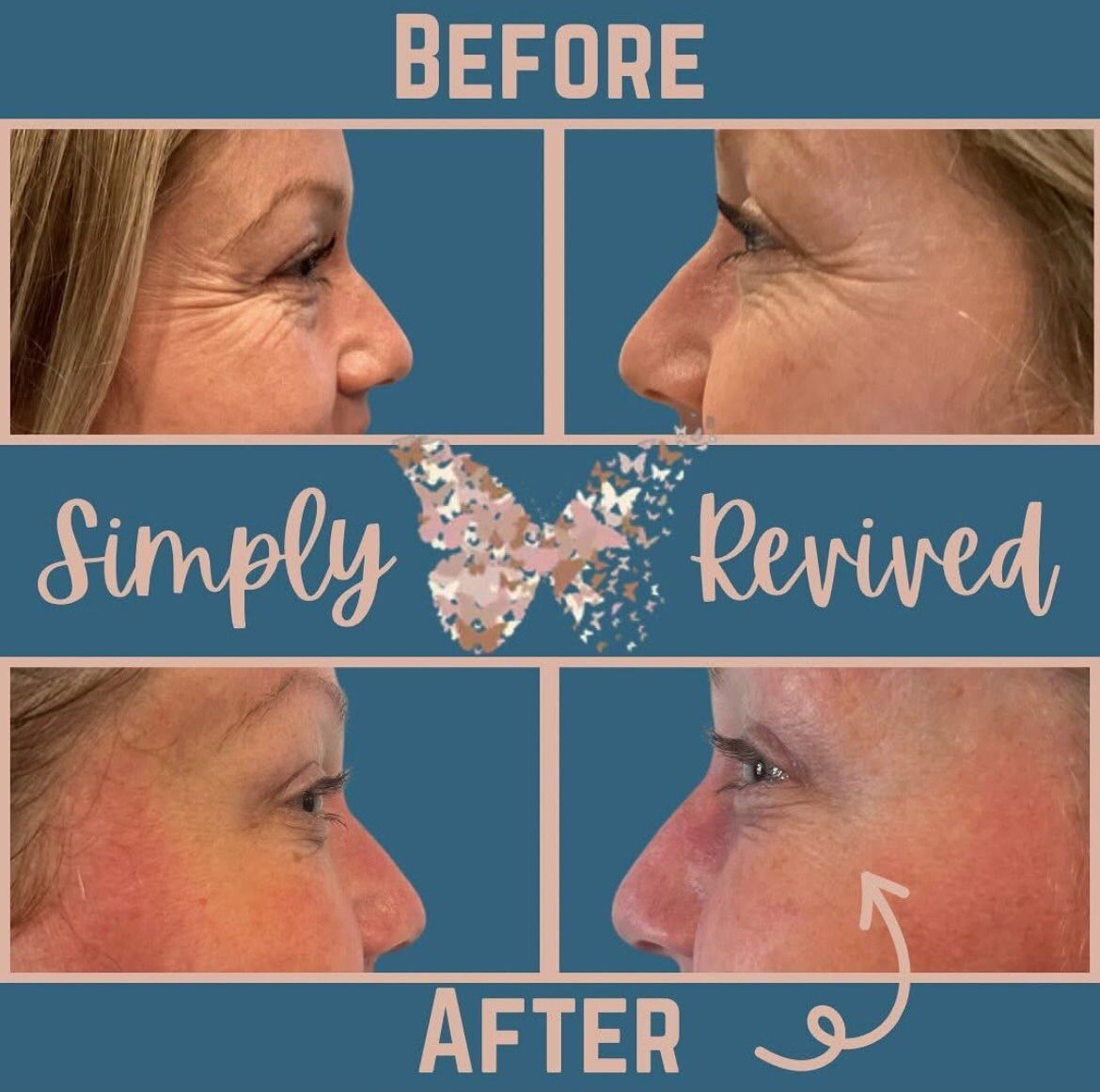 Before and after views of a person’s face, showing a reduction in wrinkles. Simply Revived logo, butterfly graphic.