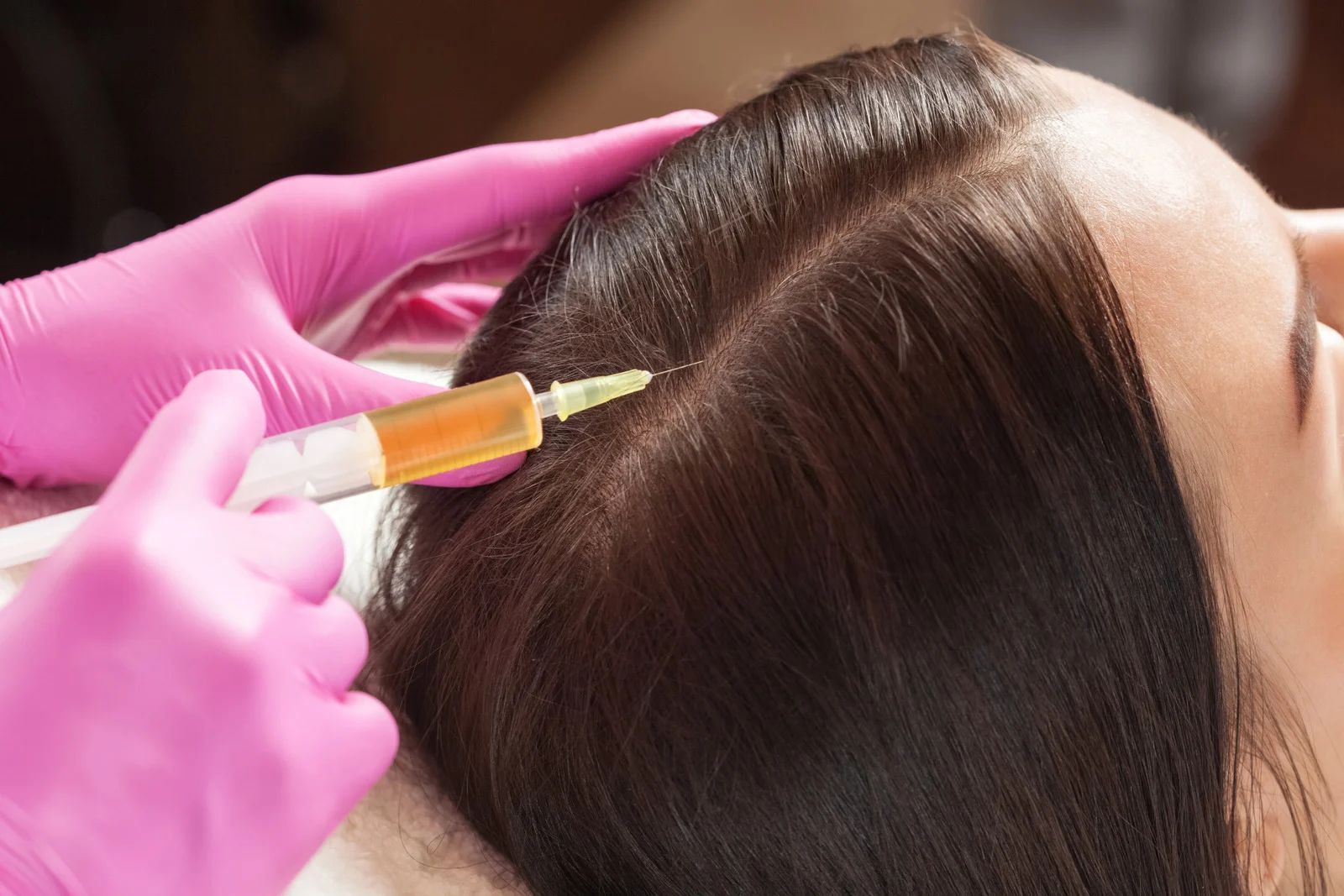 Person receiving scalp injections with a syringe, pink gloves, brown hair, close-up.