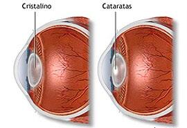 OFTALMOLOGÍA DIABÉTICA - Renitopatía