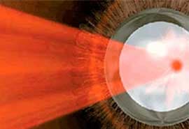 OFTALMOLOGÍA DIABÉTICA - Sangrado vitro