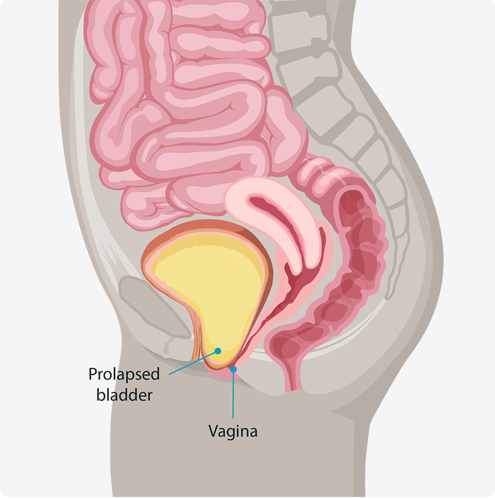 Pelvic Organ Prolapse (POP)  Southern Urogynecology Wellness & Aesthetics