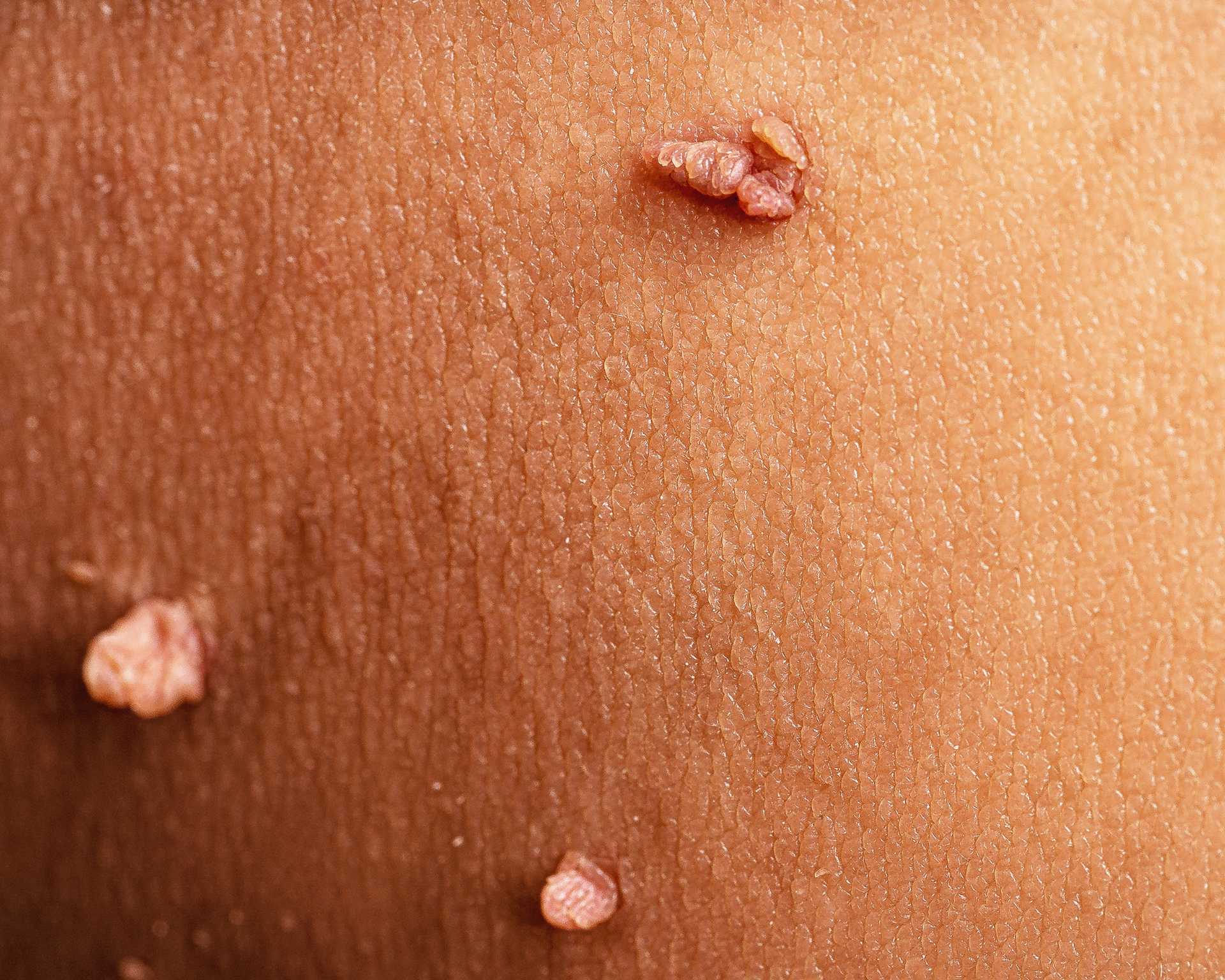 A close up of a person 's skin with skin tags