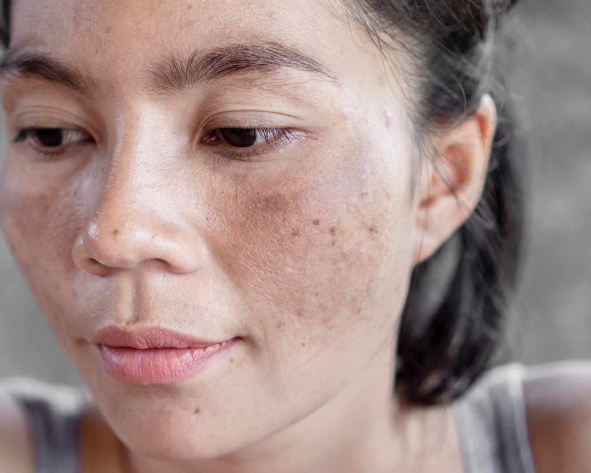 A close up of a woman 's face with spots on it.