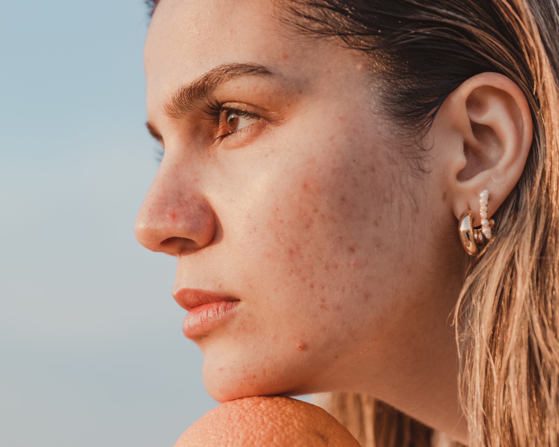 A woman with acne on her face is wearing hoop earrings.
